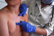 Sarampión en México: cuáles son los síntomas y cómo prevenir el contagio; aquí te explicamos