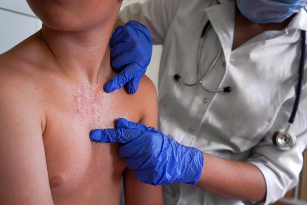 En plena época navideña, la Secretaría de Salud de Chiapas pide suspender eventos masivos en 15 municipios por casos de sarampión.
(iStock)