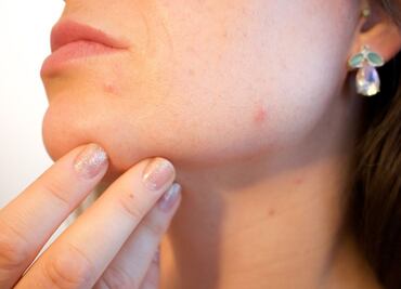 Conoce el tratamiento contra el acné que usa bacterias para combatirlo
