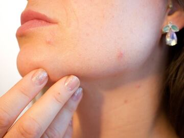 Conoce el tratamiento contra el acné que usa bacterias para combatirlo