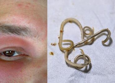 Fue al médico por una migraña y los médicos le extrajeron un gusano de 15 centímetros