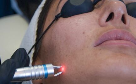 Cómo quitar las cicatrices del acné con resurfacing