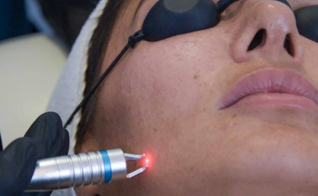 Piel firme y luminosa son algunos de los objetivos que se alcanzan con el resurfacing. Foto: Cortesía