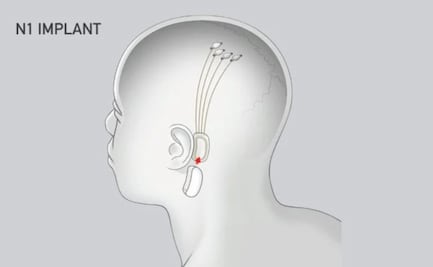 Elon Musk busca reproducir música en tu cerebro con Neuralink
