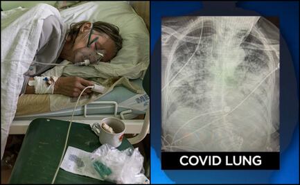 Covid-19: Pulmones quedan más dañados que los de fumadores, dice experta