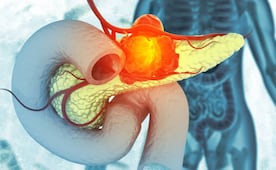 EU aprueba revolucionario fármaco contra el cáncer de páncreas; Rasonque ofrece un tratamiento más eficaz y mejora la supervivencia