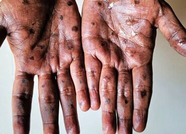 Brote de mpox: ¿Cuándo llegó la viruela del mono a México y cuántos contagios ha sumado?