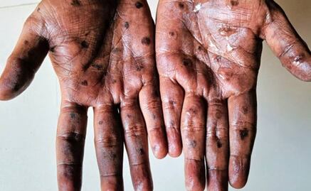 Brote de mpox: ¿Cuándo llegó la viruela del mono a México y cuántos contagios ha sumado? 