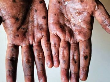 Brote de mpox: ¿Cuándo llegó la viruela del mono a México y cuántos contagios ha sumado?