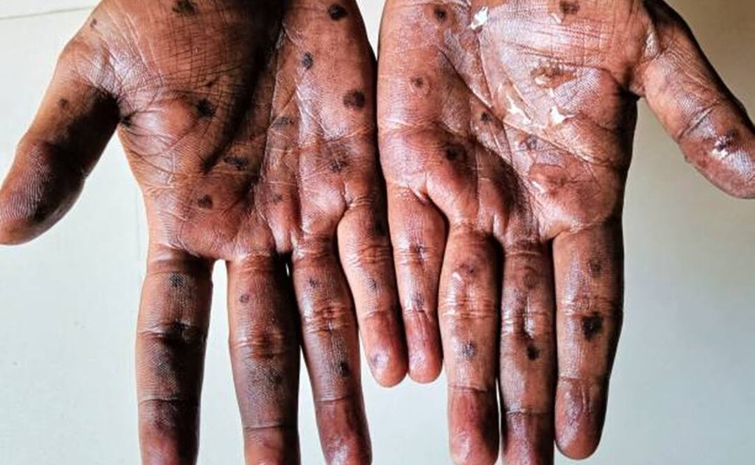 Las medidas fueron tomadas debido al número creciente de casos así como la posibilidad de contagio a zonas fuera de la RDC. Foto: Pixabay