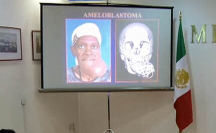 Extirpan tumor en mandíbula de paciente en Hospital Juárez