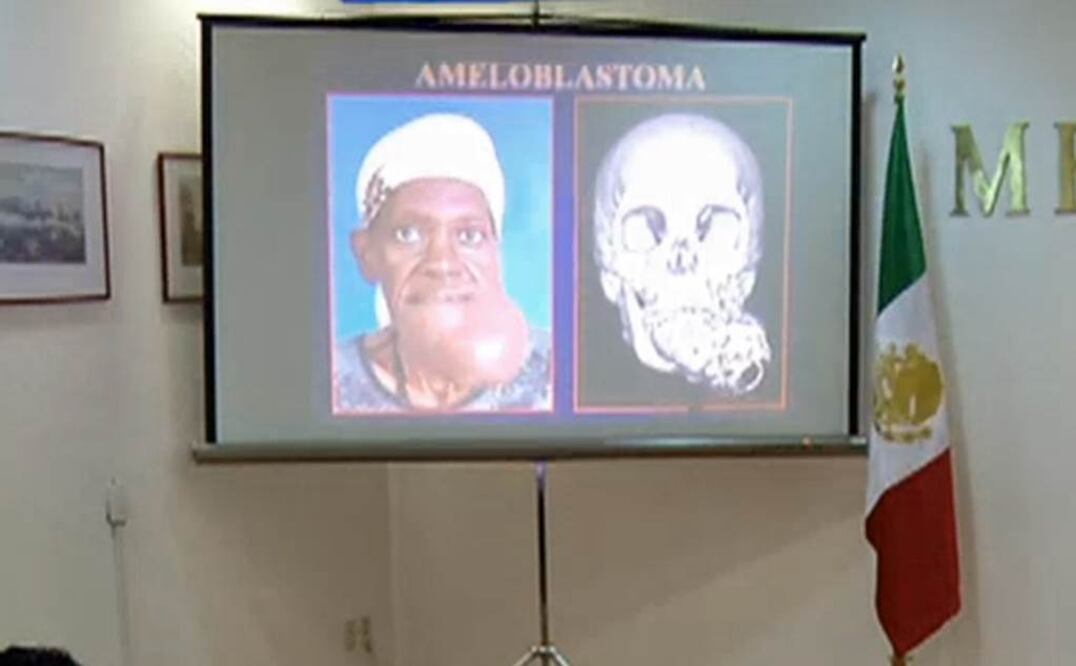 Extirpan tumor en mandíbula de paciente en Hospital Juárez