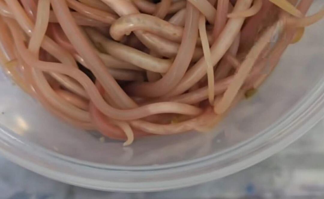 Médicos encontraron que el niño tenía 142 lombrices (Arcaris lumbricoides), una lombriz parasitaria en zonas de extrema pobreza en Chiapas (19/06/2025). Foto: Especial