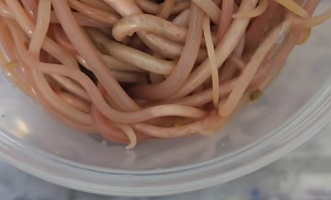 Médicos encontraron que el niño tenía 142 lombrices (Arcaris lumbricoides), una lombriz parasitaria en zonas de extrema pobreza en Chiapas (19/06/2025). Foto: Especial