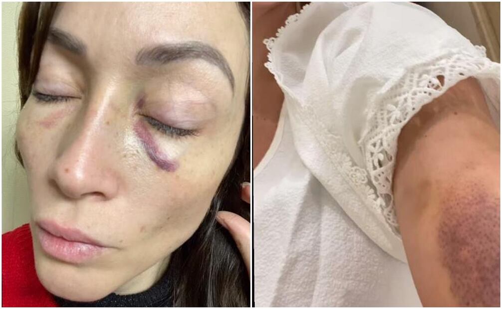 Laura Vignatti muestra la violencia por parte se su expareja "Salvador N".