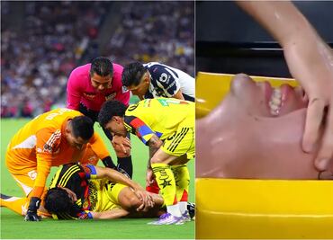 Liga MX: La espeluznante lesión de Dagoberto Espinoza, joven futbolista del Club América