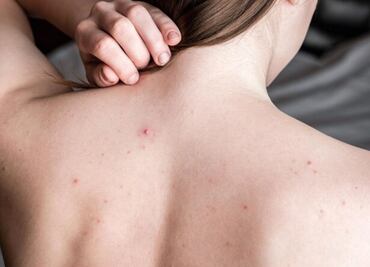 Cómo combatir el acné en la espalda