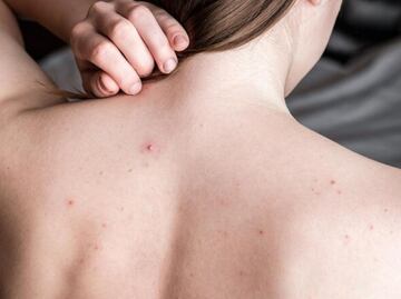 Cómo combatir el acné en la espalda