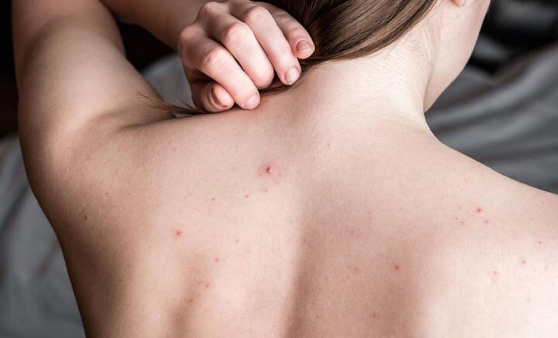 El acné es una de las afecciones de la piel más habituales. Fuente: Freepik.