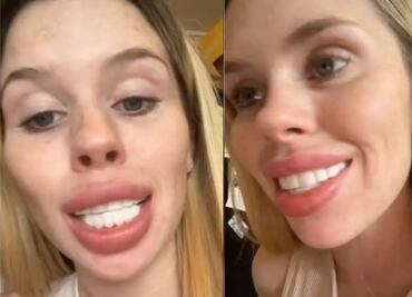 "Me veo como un caballo". Mujer se hace un “diseño de sonrisa” y el resultado la devastó