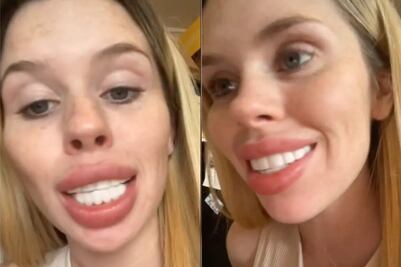 "Me veo como un caballo". Mujer se hace un “diseño de sonrisa” y el resultado la devastó