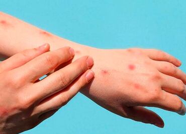 La viruela del mono no será como el Covid, pero "se va a quedar con nosotros", afirma viróloga española