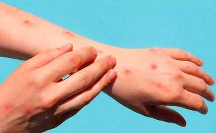 La viruela del mono no será como el Covid, pero "se va a quedar con nosotros", afirma viróloga española