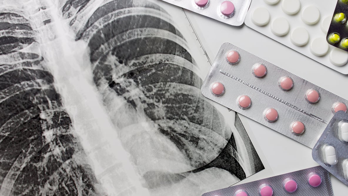 Administración de Trump recorta la ayuda internacional para la lucha contra la tuberculosis. Foto: archivo