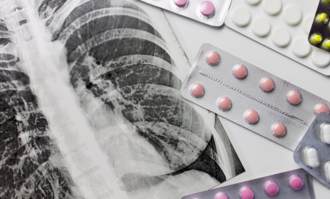 Administración de Trump recorta la ayuda internacional para la lucha contra la tuberculosis. Foto: archivo