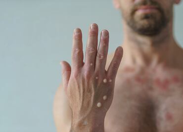 Confirman primera muerte por Mpox en Jalisco; hay 62 casos registrados en el estado en lo que va del año