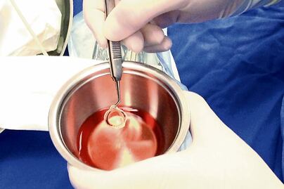 Destacan avances en trasplantes de córnea