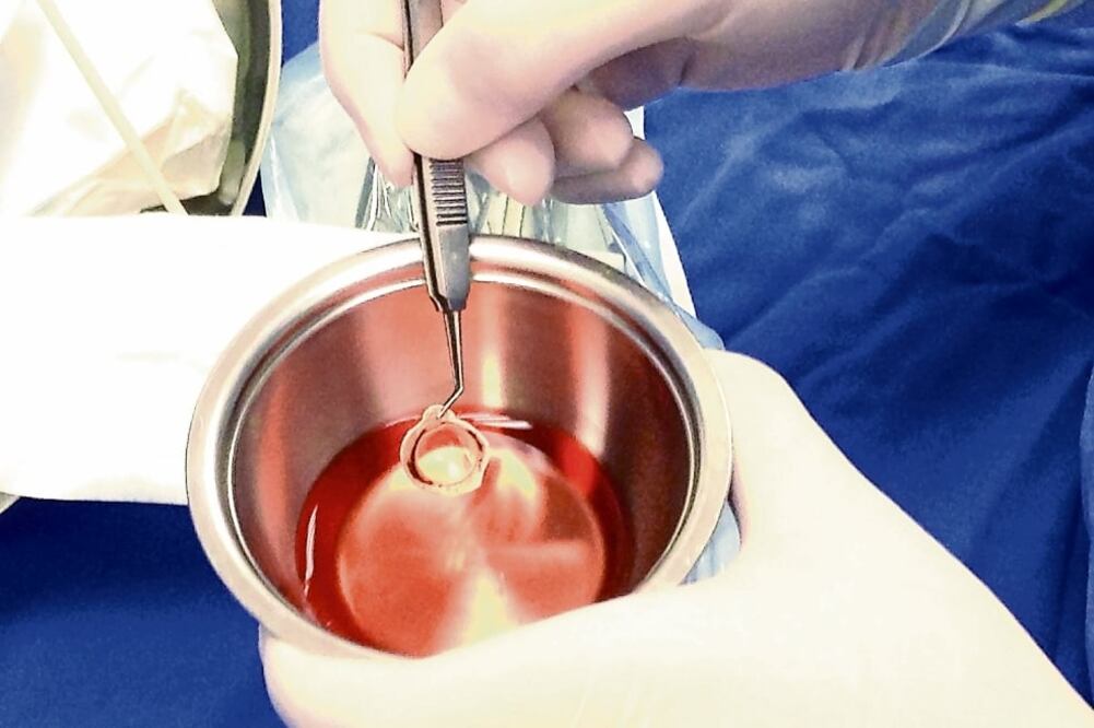 El trasplante de córnea consiste en reemplazar el tejido que se encuentra dañado o enfermo por uno completamente sano (ESPECIAL)