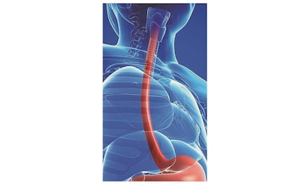 Alertan sobre el esófago de Barrett, enfermedad poco conocida