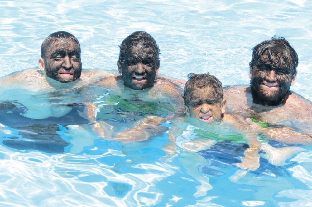 Chuy sufre hipertricosis congénita lanuginosa, el síndrome del hombre lobo; no es el único, desde hace varias generaciones su familia lo padece (CORTESÍA)