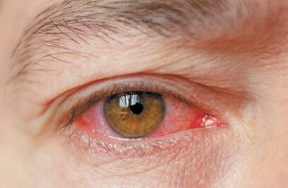 Conjuntivitis, el otro síntoma que indica que contrajiste Covid-19 