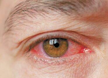 Conjuntivitis, el otro síntoma que indica que contrajiste Covid-19