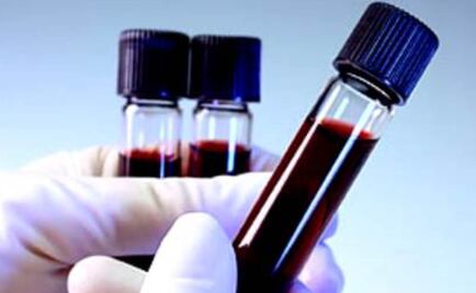 Establecen catálogo genético de leucemia linfática crónica