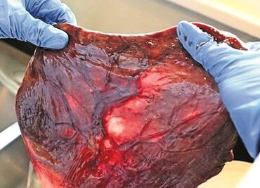 Descubren que microplásticos llegan hasta la placenta humana