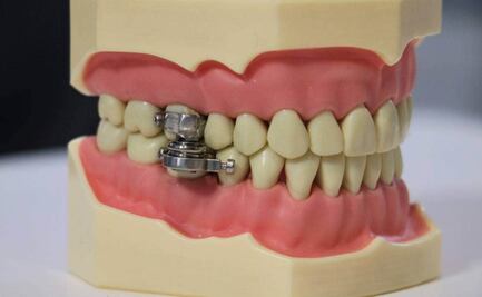 Conoce la tecnología que cierra tu boca para que bajes de peso