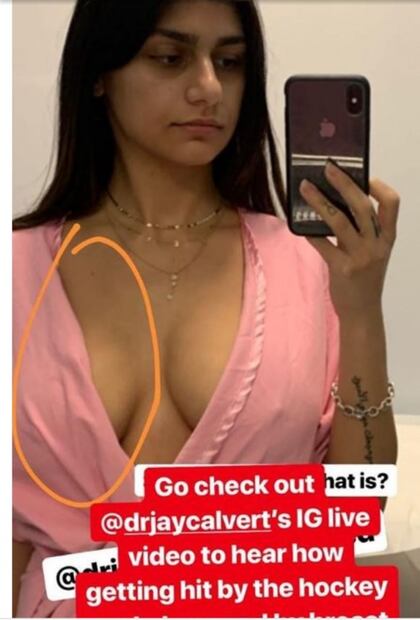 Ex actriz porno se opera un seno por culpa del hockey