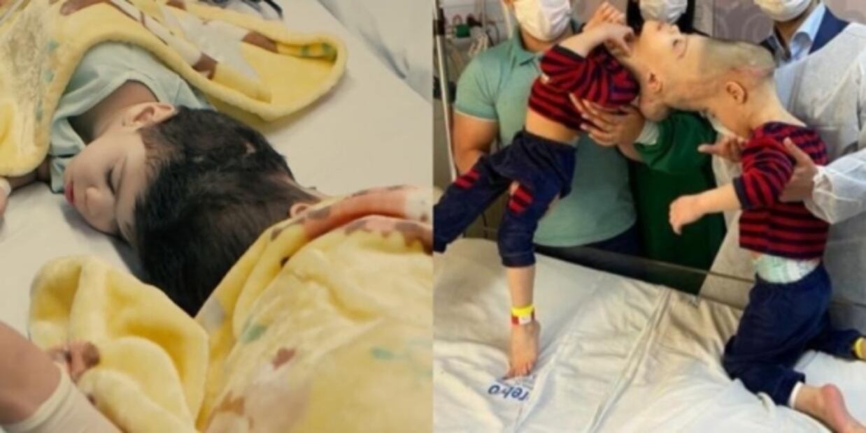 Fotos. Logran con éxito separación de siameses unidos por la cabeza en Brasil