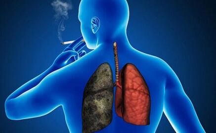 El cáncer de pulmón sigue su desconocido y "desalentador" avance en América