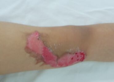 Injerto de piel cultivada salva a niña de 7 años