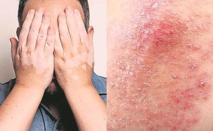 Beneficios de la radiación ultravioleta