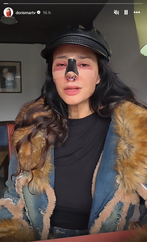 Dorismar during recovery after nasal reconstruction