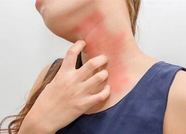 Científicos identifican posible origen de las reacciones alérgicas