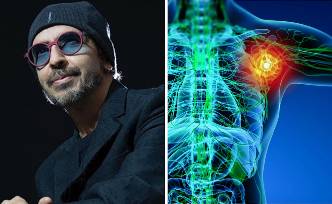 Un tipo de cáncer del sistema linfático que afecta el sistema inmunológico y puede propagarse a otras partes del cuerpo.
Foto: El universal