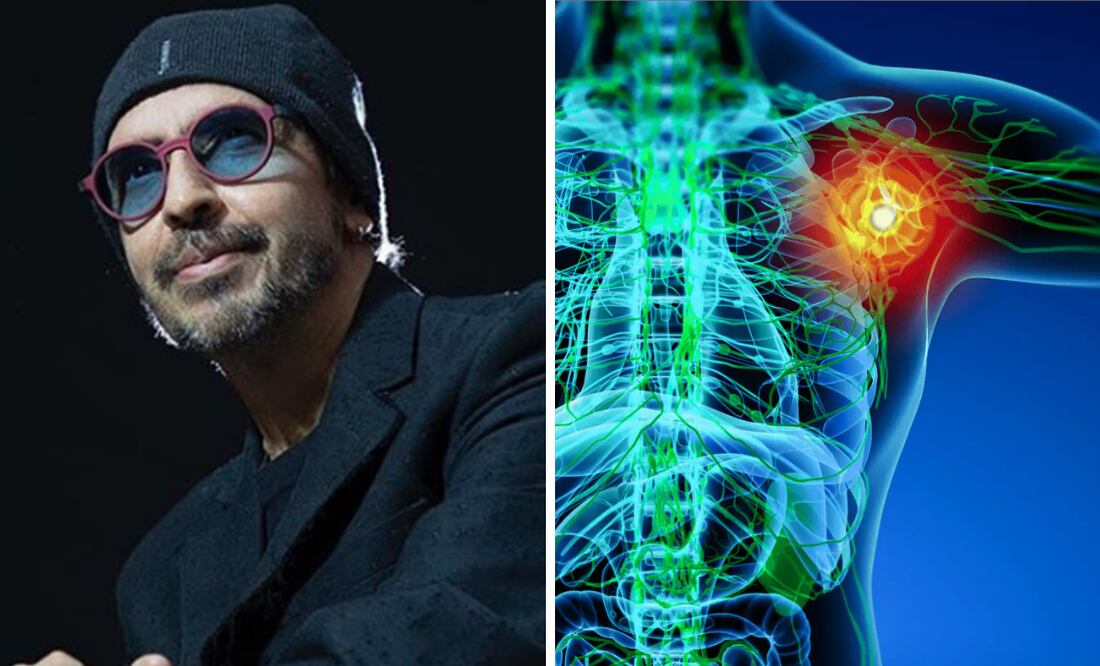 Un tipo de cáncer del sistema linfático que afecta el sistema inmunológico y puede propagarse a otras partes del cuerpo.
Foto: El universal