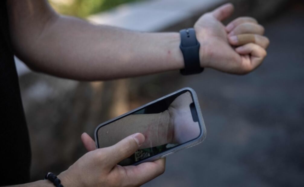 "Los peores dolores de mi vida": neoyorquino cuenta cómo fue tener viruela del mono