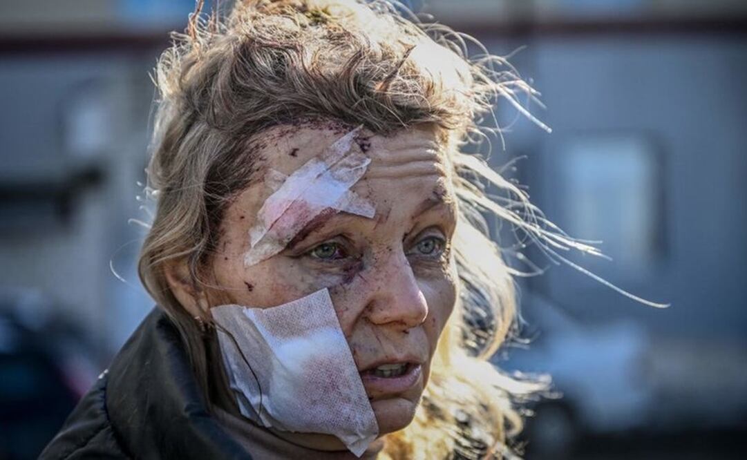 Una mujer que resultó herida por los bombardeos rusos se convirtió en objeto de teorías de conspiración y afirmaciones falsas en internet. Foto: Getty Images